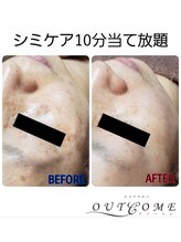 アウトカム(OUTCOME)/人気NO.1！！シミケアメニュー