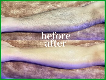 ハモンド(Hammond)/脚脱毛/スネ毛脱毛