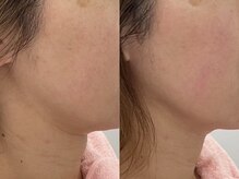 サクラ(SAKURA)/本厚木/フェイシャル/シミ