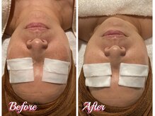 アイラブワン(eye love one)/光フォト【小顔/美白/たるみ】