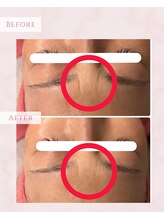 プレジール(Plaisir)/サーマトリックス+サイトカイン