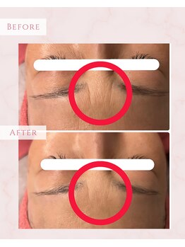 プレジール(Plaisir)/サーマトリックス+サイトカイン