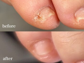 爪のいろは/小指の引っ掛かりも綺麗に除去♪