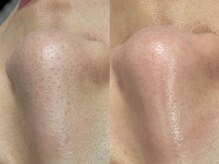 ヴィーヴ 京橋(vive)/【韓国式3D毛穴洗浄】