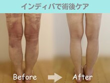 ナナ 銀座(Nana)/術後ケアはぜひインディバに任せ