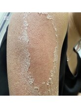 モカ 天王寺店(MOKA)/剥離3回　二の腕　ブツブツ