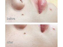 柏ベルミーランド/脱毛before→after