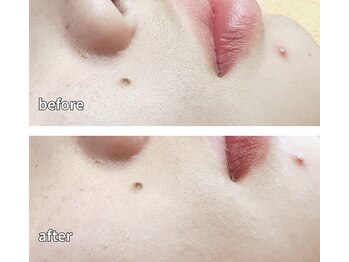 柏ベルミーランド/脱毛before→after