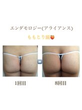 アイリス(AIRIS)/痩身/エンダモロジー/むくみ