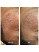 ユカリス(Yu.charis)/ハーブピーリング before/after