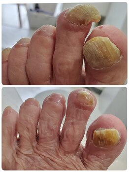 セイラ(Seila)/ご高齢の方の爪