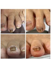 ドクターネイル爪革命 十条店/肥厚爪ケア