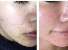 シード(SHE°)/陶肌トリートメント