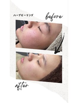 ベル(Belle)/ハーブピーリング￥9,800