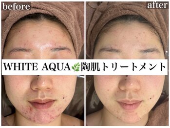 ホワイトアクア 池袋店(WHITE AQUA)/ハーブピーリング/ニキビケア