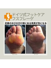 フスフレーゲ 学芸大学店/指の付け根の角質のお悩み