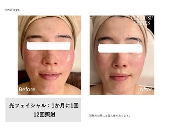 フェレザ 新潟(Felleza)/光フェイシャル女性スタッフ施術