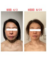 リラココ(リラcoco)/ビフォーアフター（50代お客様）