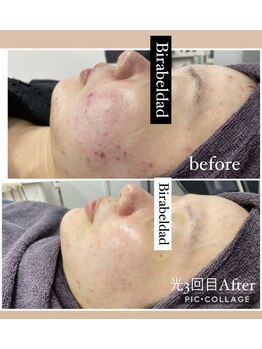 ビラ ベルダ(Bira Beldad)/