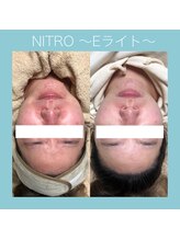 ビーダブリュー(BW...)/Eライト（光＋高周波)赤ら顔改善