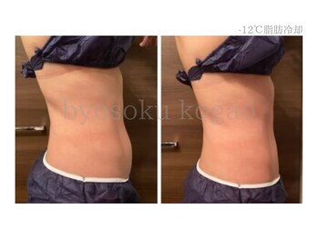 メディカルエステ 新宿店/＊日本初-12℃脂肪冷却症例＊