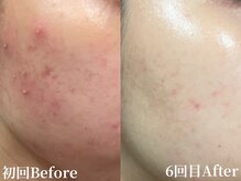 アンバー(amber)/ハーブピーリングで肌質改善