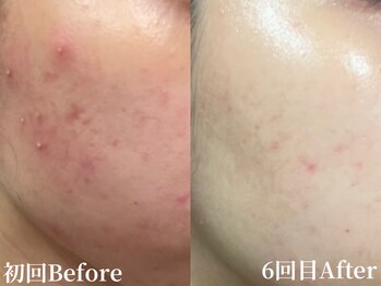 アンバー(amber)/ハーブピーリングで肌質改善