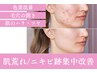 〈繰り返しニキビ＆赤み肌改善〉ピーリング＋無針ビタミンC導入コース
