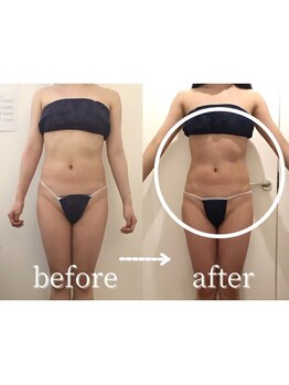 ボーレーヴ(beau reve)/ブライダル/インディバ/痩身