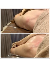 オーシャン(OCEAN)/猫背巻肩姿勢改善に