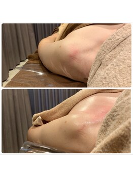 オーシャン(OCEAN)/猫背巻肩姿勢改善に