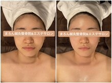 まろん鍼灸接骨院 立川店/小顔矯正コルギBefore→After！