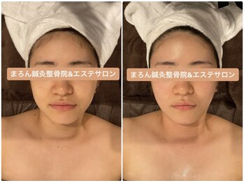 まろん鍼灸接骨院 立川店/小顔矯正コルギBefore→After！