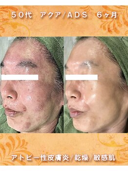 ナイア(naia)/アクアヴィーナス使用症例