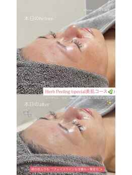 クレヴィー(Creviy)/Special美肌コース1回の変化