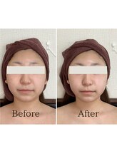 エミニー バイ エルズ(Eminy by L★s)/10代　小顔コルギ　2回