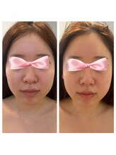 美温(mion)/術前インディバ