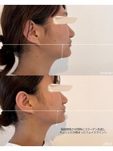 サンク(cinq)/インモードでEライン形成