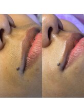 シュガーリングハウスレディ(SugaringHouse LADY)/フェイシャル脱毛