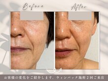 碧(ao)/ウィンバック２回の効果！