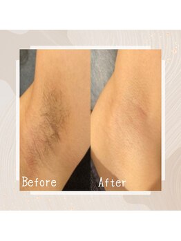 ルミナ(Lumina)/レディース脱毛