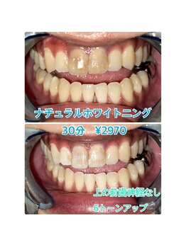 プラチナムビューティー 川口駅前店(PLATINUM BEAUTY)/長年気になっていたお悩み解決