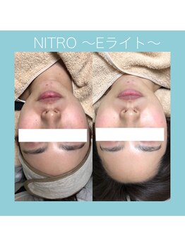 ビーダブリュー(BW...)/Eライト（光＋高周波)くすみ改善