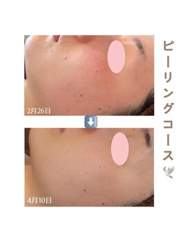 アイリス(AIRIS)/メンズフェイシャル/ニキビケア