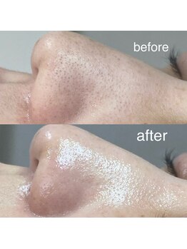 サロン ド ソワン(salon de soin)/毛穴エクストラクション