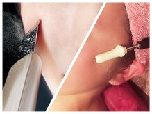 スキンケアスタジオ アコ 新宿店(Aco)/［毛穴洗浄&ビタミンC］お顔ケア