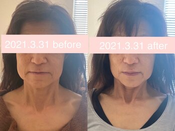 サクラ(SAKURA)/本厚木/フェイシャル/シミ