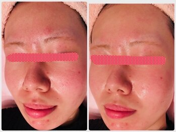 ディオーネ 新潟けやき通り店(Dione)/毛穴洗浄コース