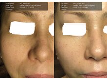 ドクターピュールボーテ 神戸店(Dr. PUR BEAUTE)/たるみ・くすみケア