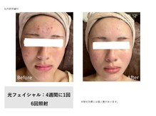 フェレザ 新潟(Felleza)/光フェイシャル女性スタッフ施術